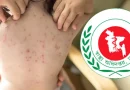 হামের উপসর্গ নিয়ে আরও ৫ জনের মৃত্যু, মোট প্রাণহানি ৮২৫