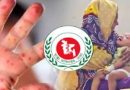হামের উপসর্গে আরও ৪ জনের মৃত্যু, মোট মৃত্যু ৯২২ জন